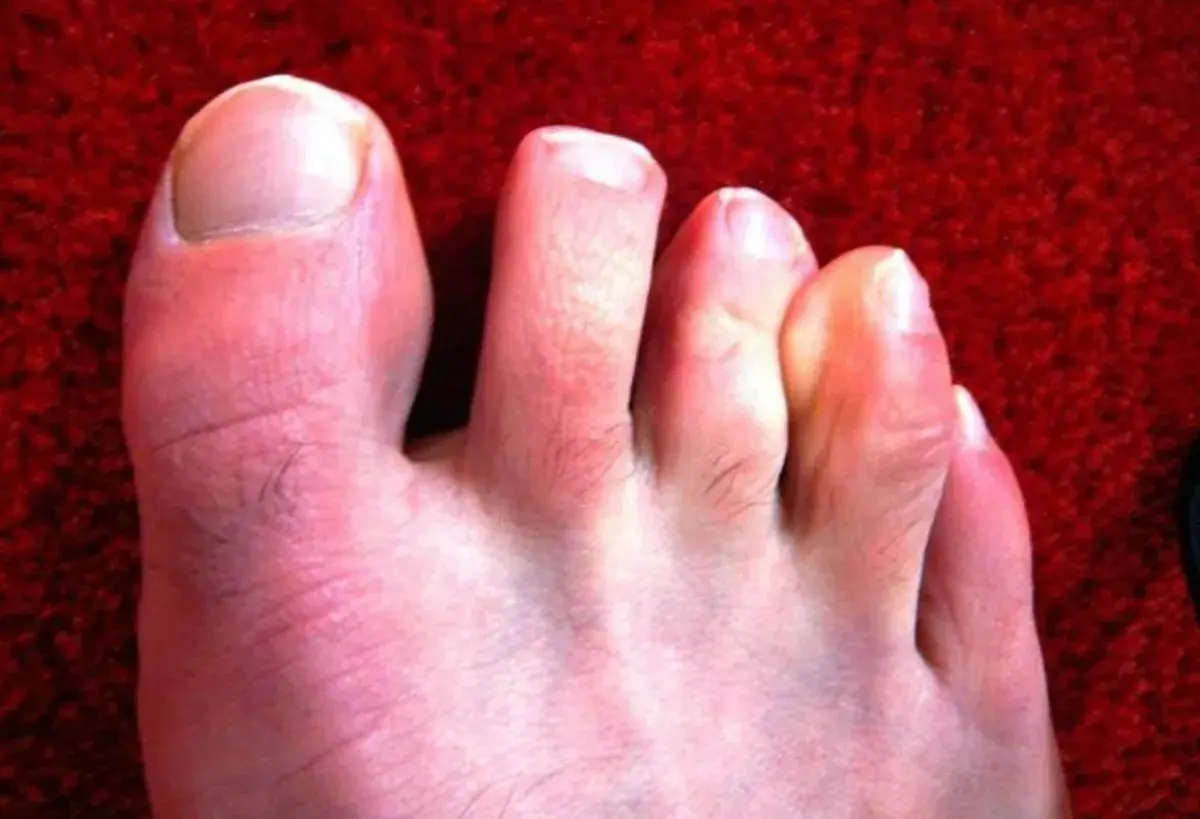 Kladívkové prsty. Jak jim předcházet a jak je léčit