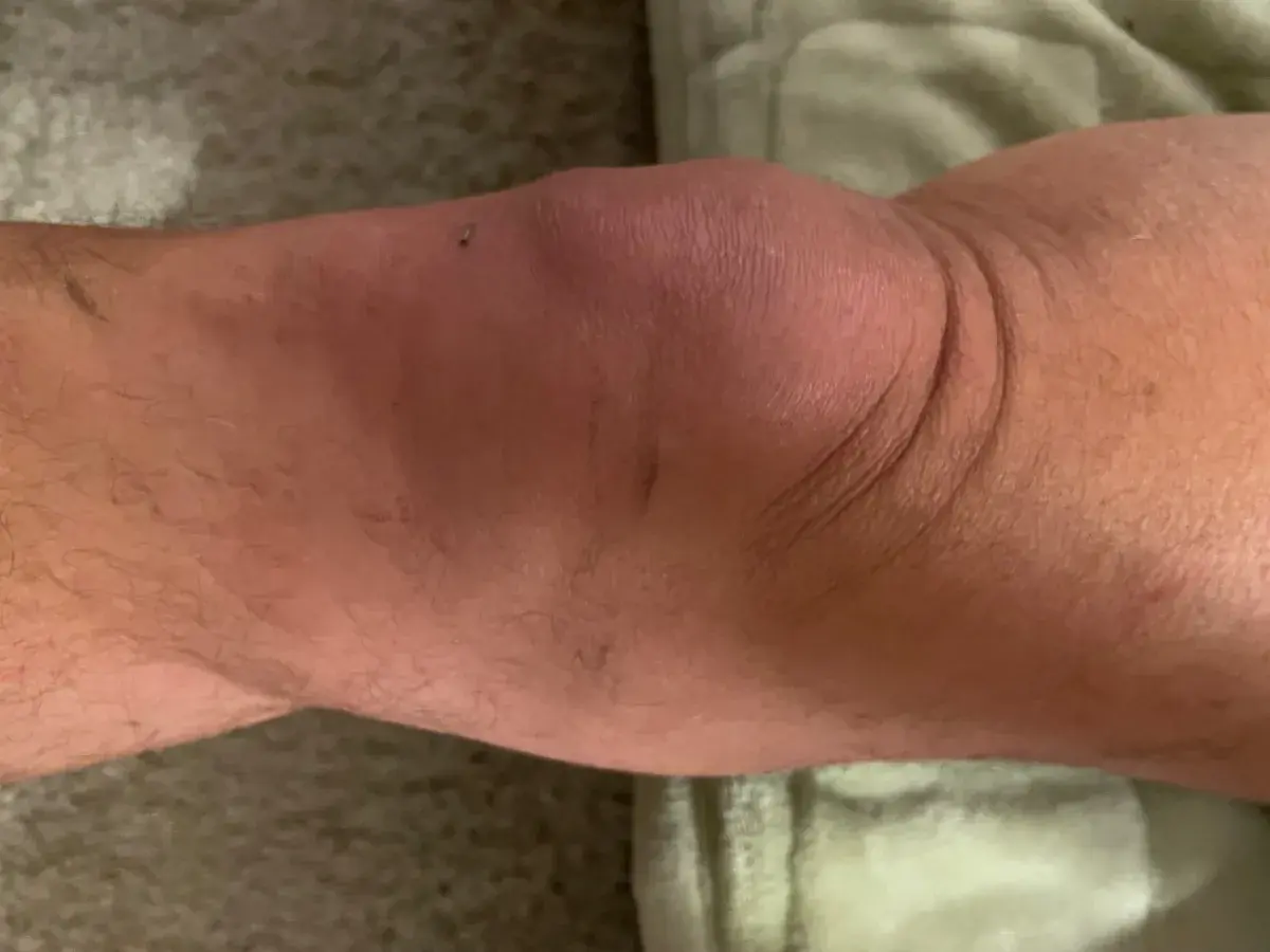 Úrazy kolene. Jak jim předcházet a jak je léčit