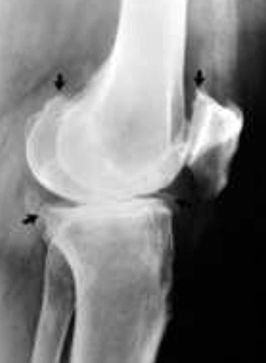 Bolesti kloubů, jak jim předcházet, co s tím, když omezují náš pohyb - poškozené koleno
